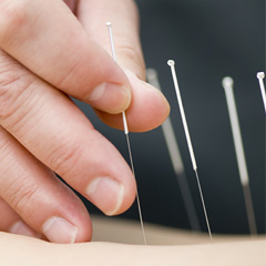 Akupunktur